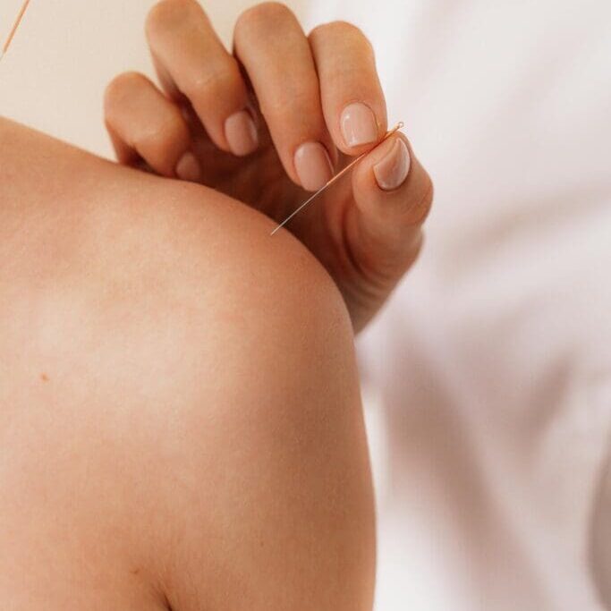 Acupuncture needle on shoulder during treatment.